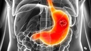 武汉弘医堂丨萎缩性胃炎伴肠化会癌变吗如何逆转
