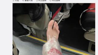 郭艾伦晒右脚受伤照片：应该没大碍，疼也要上场