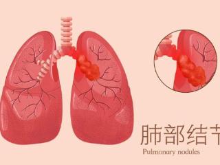 肺部查出小结节，发展到肺癌需要几年？