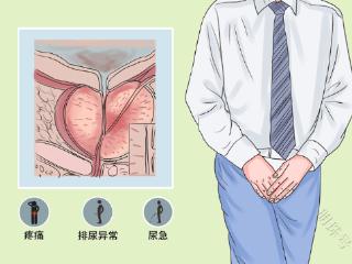 前列腺疾病是男性常见多发病，四大症状别忽视