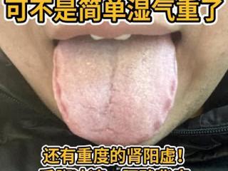 舌诊分析：齿痕舌就是湿气重？大错特错！4个门诊案例教你辩舌！