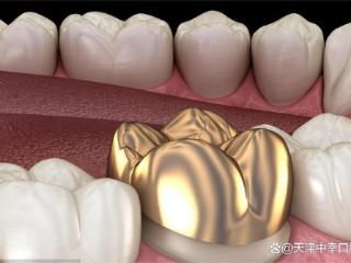 为什么有的种植牙只能选择金属牙冠？