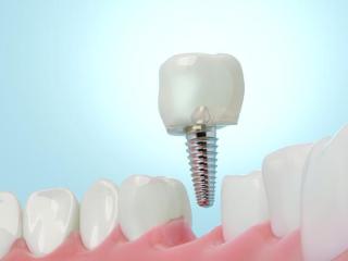种植牙手术会损伤旁边的神经和血管？