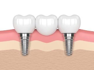 种植牙全过程一般需要多长时间？