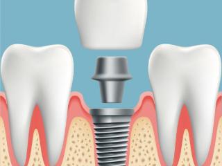 镶牙还是种植牙？选择适合你的牙齿修复方案