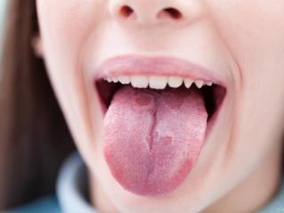 望舌苔之 痿软舌 强硬舌 歪斜舌临床意义