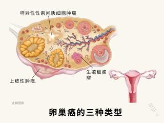 导致卵巢癌的因素有哪些，女性患有卵巢癌有哪些症状？