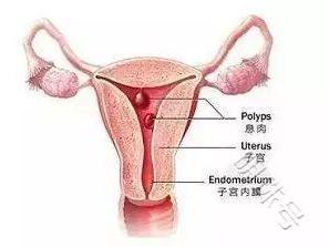 多年不孕，原来是内膜息肉在作怪