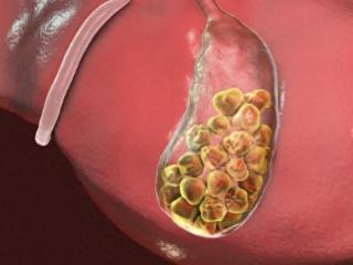 提醒没了胆囊的人：这4种食物再好吃也建议忌口，否则受罪的是你