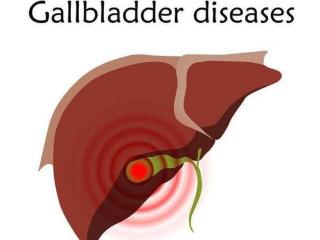 查出胆囊息肉要切除？若这5个条件你中了1个，建议立刻切除