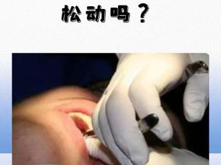 智齿拔除对邻牙的影响：松动？真相揭晓