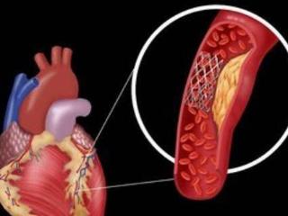 什么是动脉硬化？吃什么才能软化血管