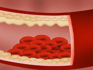 体内有血栓会有什么表现？疏通血管应该如何做？