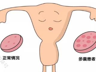 多囊卵巢综合症该如何备孕？别着急听说这才是关键!