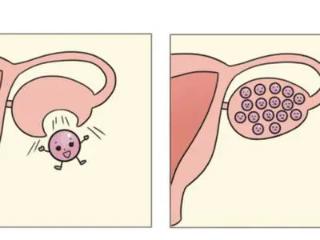 关于治疗多囊的一些错误认知。对于这些误区，你都规避了吗?