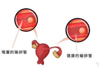 35%不孕背后元凶：输卵管堵塞全解析，你中招了吗？