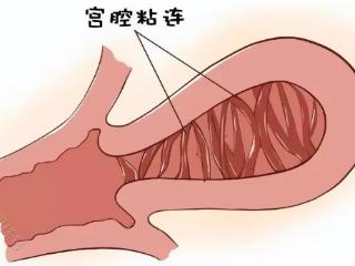 宫腔粘连不要怕，及时治疗就有希望!