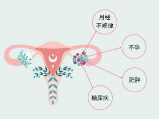 多囊卵巢综合征为何“青睐”这一女性群体？她们大多有这些特点