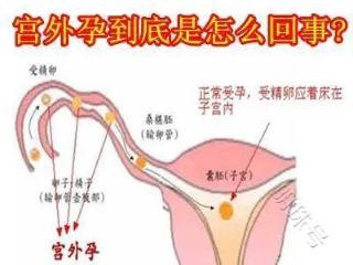 昆明送子鸟：宫外孕与正常怀孕的区别是什么？一般多久后能发现？