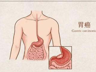 胃肠间质瘤，是胃癌还是肠癌？良恶之分由这项指标决定