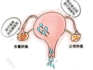 多囊难怀孕？NO!请收好这份怀孕攻略~