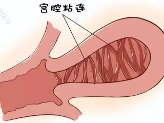 什么是宫腔粘连？宫腔粘连有这么多危害