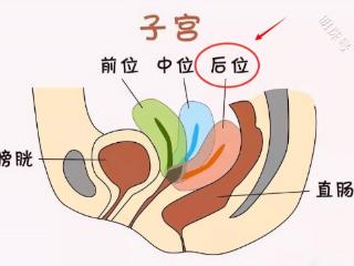 子宫后位该怎样把子宫“挪”到最佳受孕位?