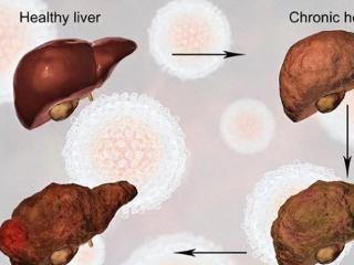 肝脏的“胰岛素”终于找到了，早晚喝一杯，摘掉肝病“帽子”