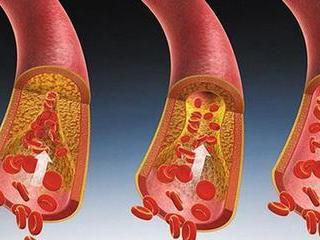 血管决定生老病死，多吃这些可清理血管垃圾