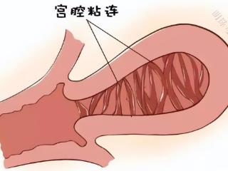 究竟什么是宫腔粘连?会不会影响怀孕?能不能治疗?