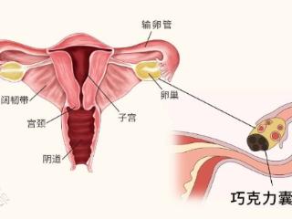 巧克力囊肿跟吃巧克力有关吗？它是怎么影响怀孕的？