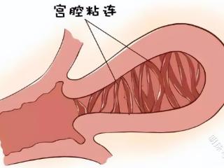 什么是宫腔粘连?宫腔粘连的危害又有哪些呢