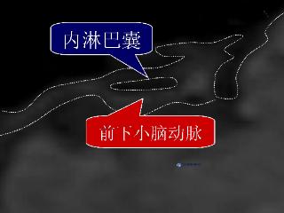 台湾耳鸣眩晕权威警示:「内淋巴囊血管压迫症」让医师也中招