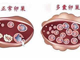 吃出健康，调理多囊