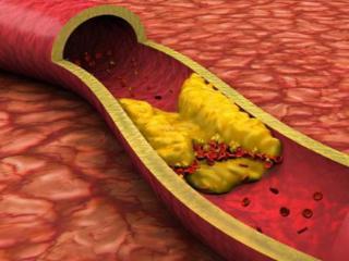 45岁后，动脉粥样硬化发展速度加快，教你5招保护血管