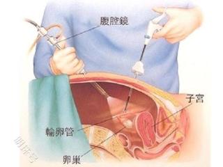 输卵管疏通手术后，为什么要复查？