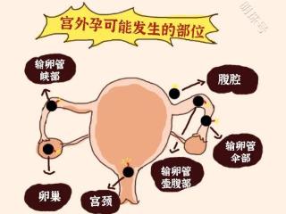 宫外孕喜欢这5种人，快来看看有你吗?