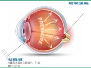 兰州爱尔眼科韦萍院长丨青光眼有哪些不同的类型？