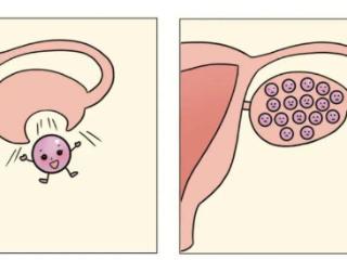 多囊卵巢综合症不仅不容易怀孕，即使怀上也易流产！