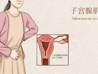 子宫腺肌症：被忽视的女性“不死癌症”！