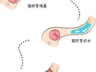 没有人流也会堵塞？输卵管堵塞的原因究竟是什么？