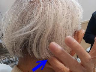 台湾耳鸣眩晕权威分享特殊病例:口腔溃疡引发的神经性偏头痛