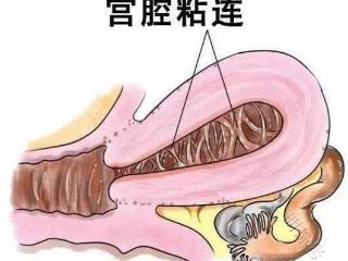 90%的宫腔粘连都会导致不孕！