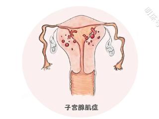 带你了解比生孩子都痛的子宫腺肌症到底有多痛！