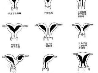 “我的子宫形状畸形，会影响怀孕和生产吗？”