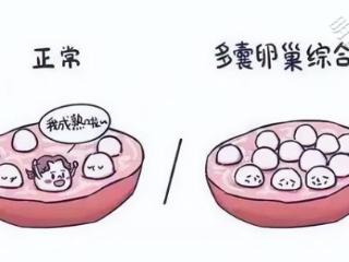 多囊卵巢综合征，需要被读懂的几个身体信号