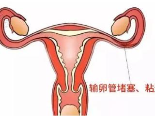 输卵管粘连：认清备孕路上的这道“隐形路障”
