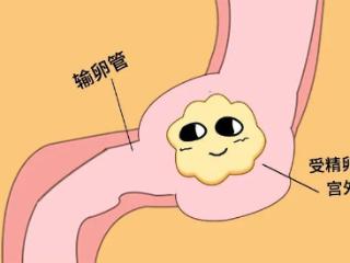 都是宫外孕，为啥有的就得切掉输卵管?