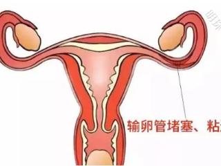 当备孕面临输卵管问题， 你该如何应对!