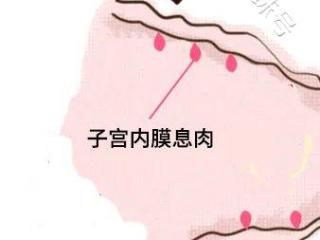 子宫内膜息肉会影响怀孕吗?_需不需要治疗?